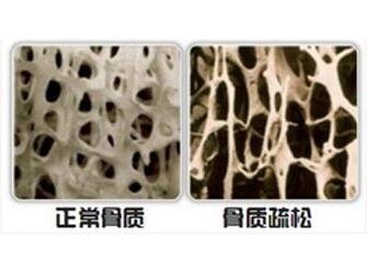 博艺堂bo98厂家-山东国康提醒常做“健骨操”，防止骨质疏松